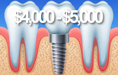 Dental implant prices  Perth.