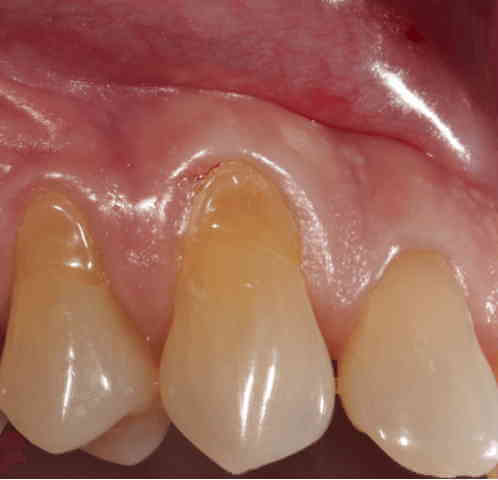 gum disease treatment Perth