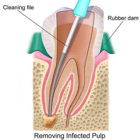Root Canal Perth