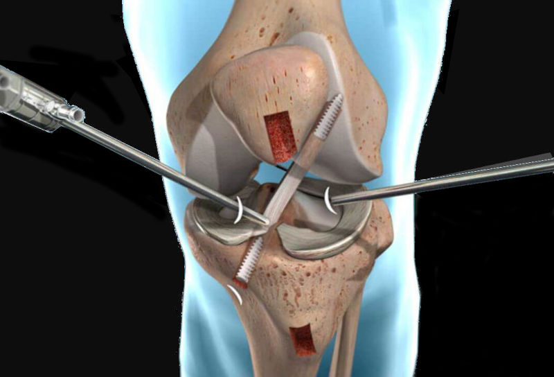 ACL surgery Perth doctor