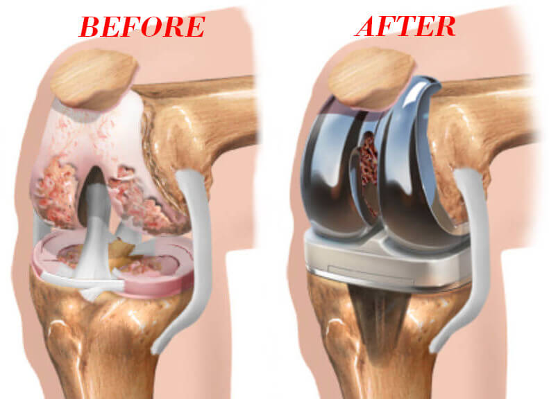knee replacement Perth